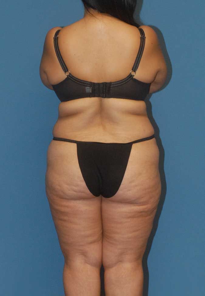 Liposuction Before & After