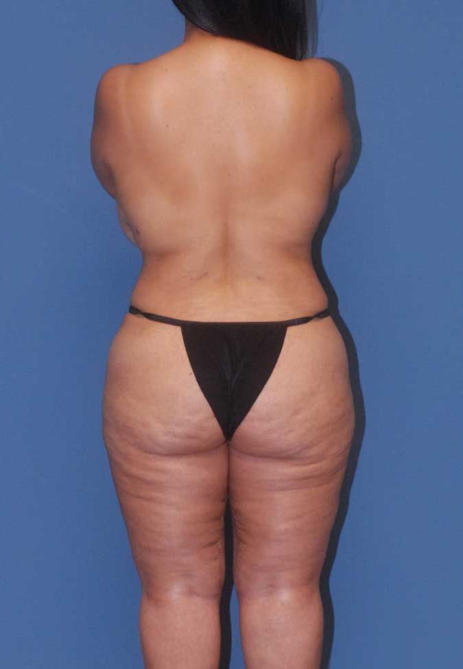 Liposuction Before & After