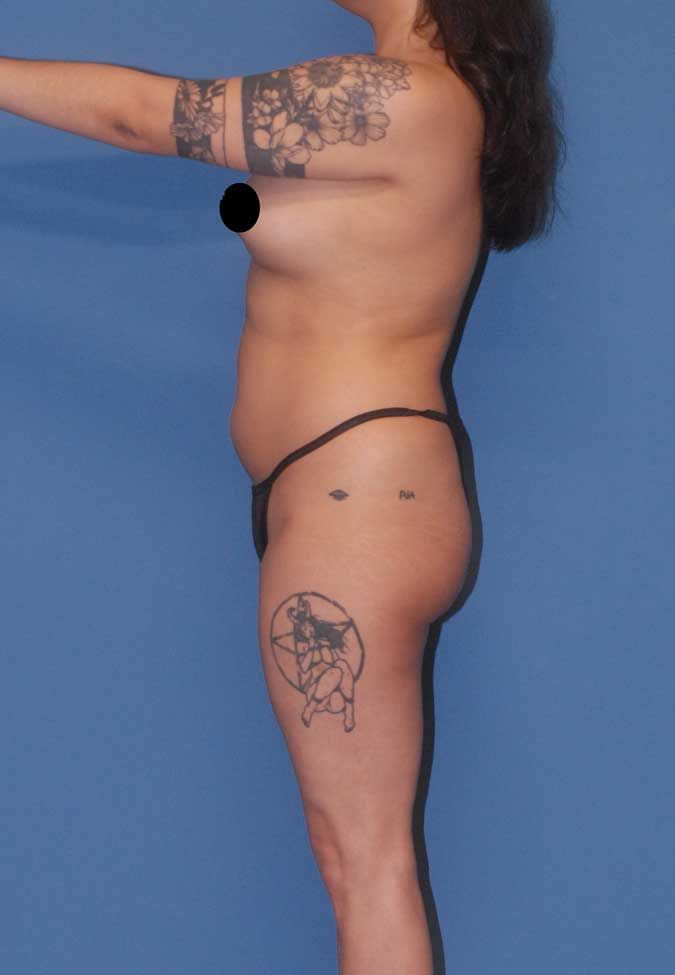 Liposuction Before & After