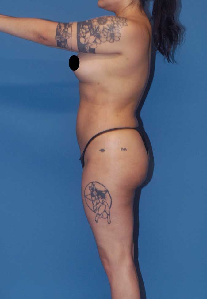 Liposuction Before & After