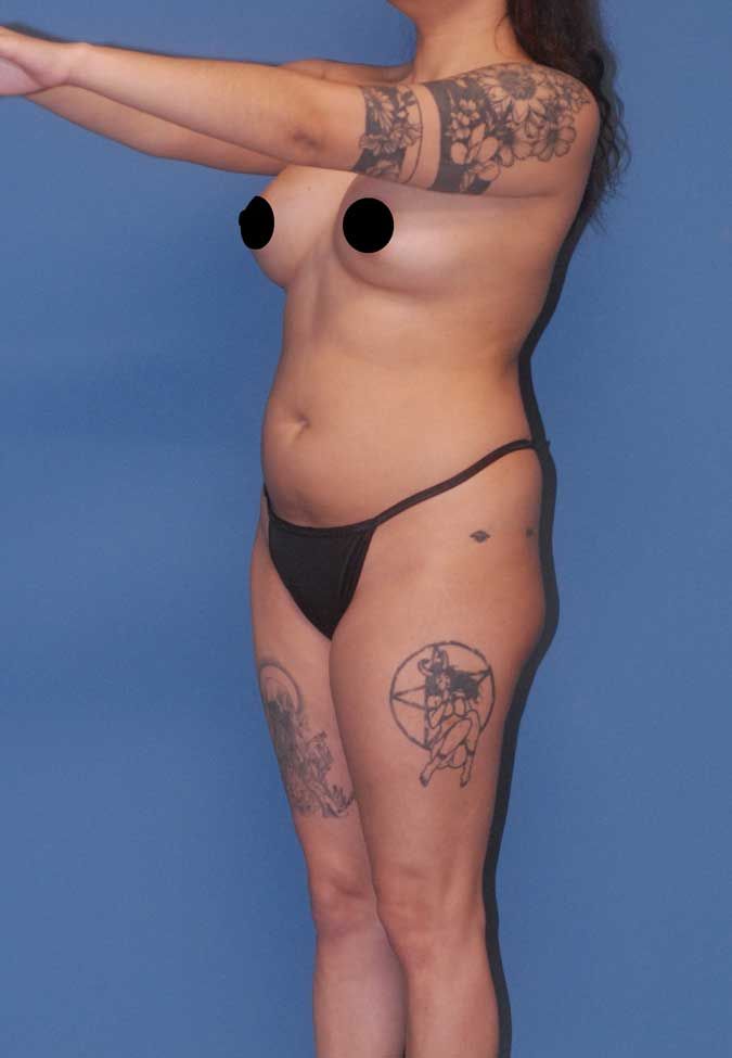 Liposuction Before & After