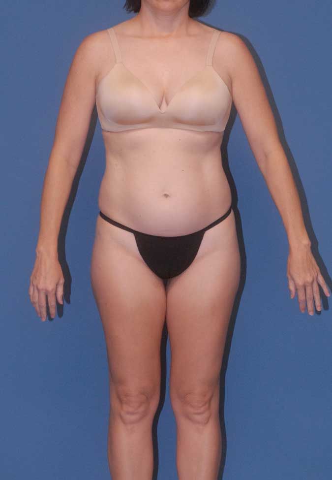 Liposuction Before & After
