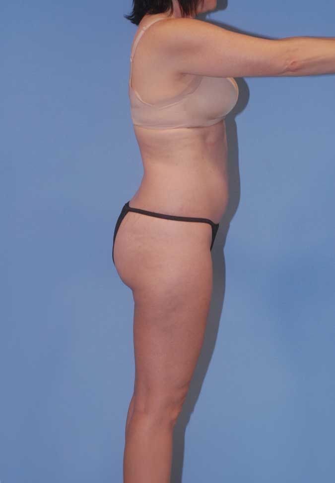 Liposuction Before & After