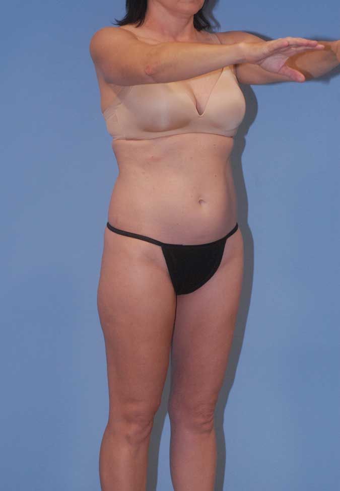 Liposuction Before & After