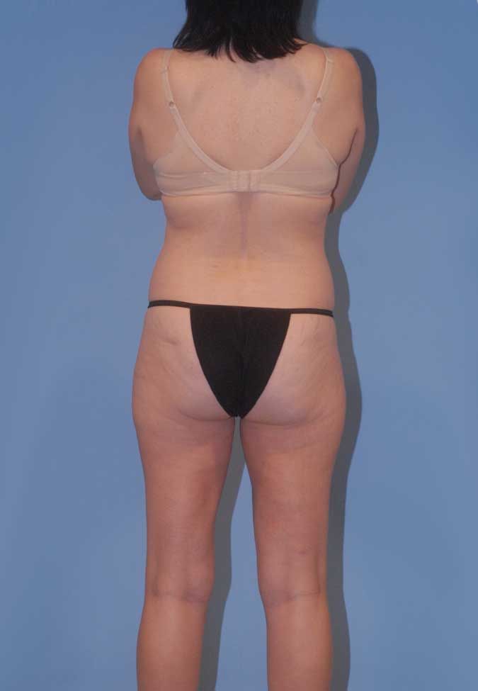 Liposuction Before & After