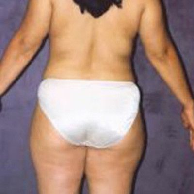 Liposuction Before & After