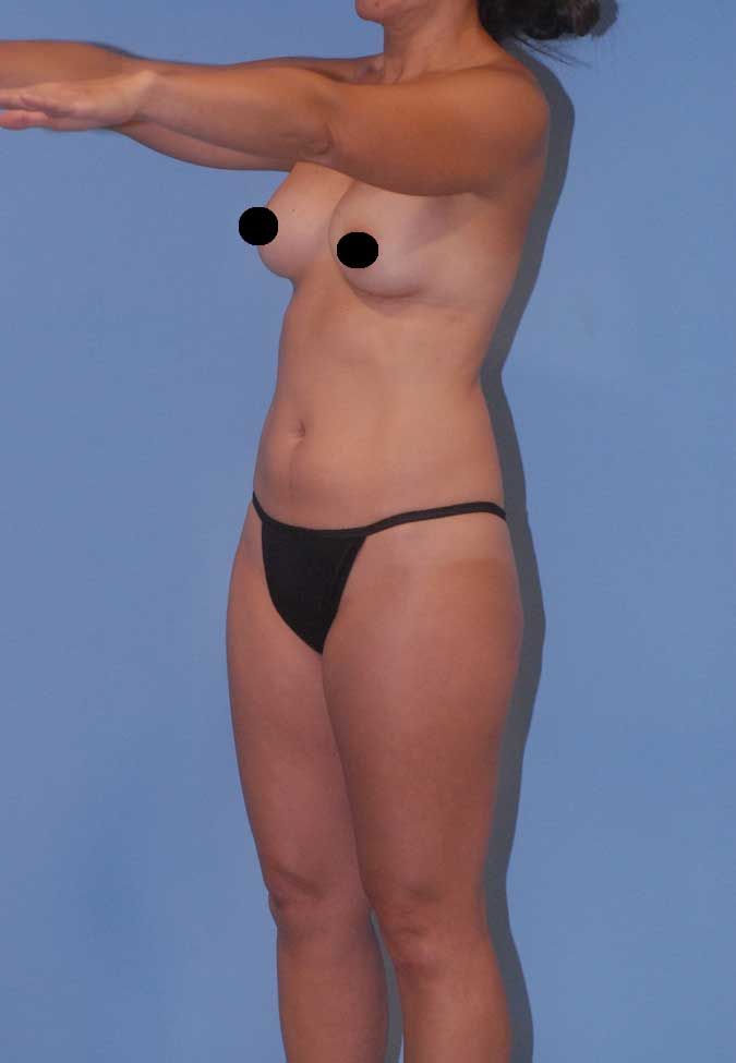 Liposuction Before & After