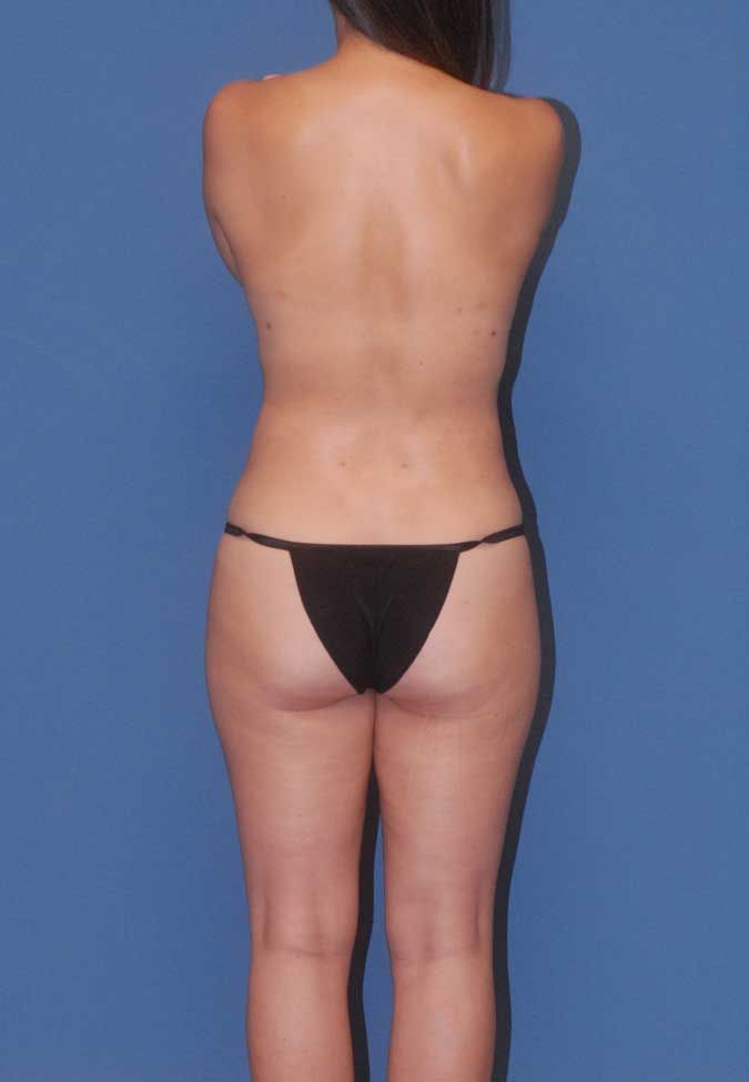 Liposuction Before & After