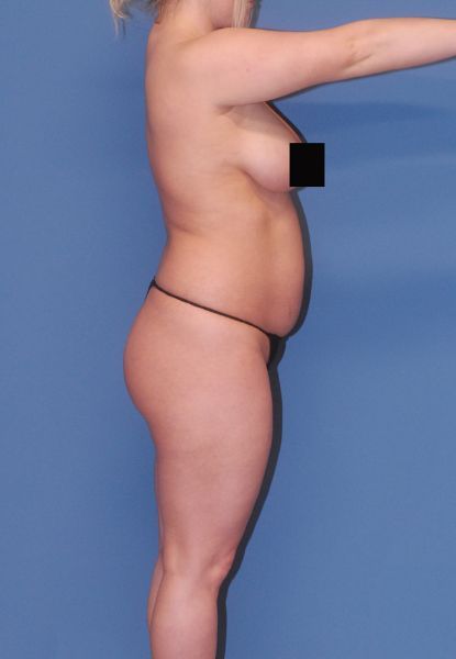 Liposuction Before & After