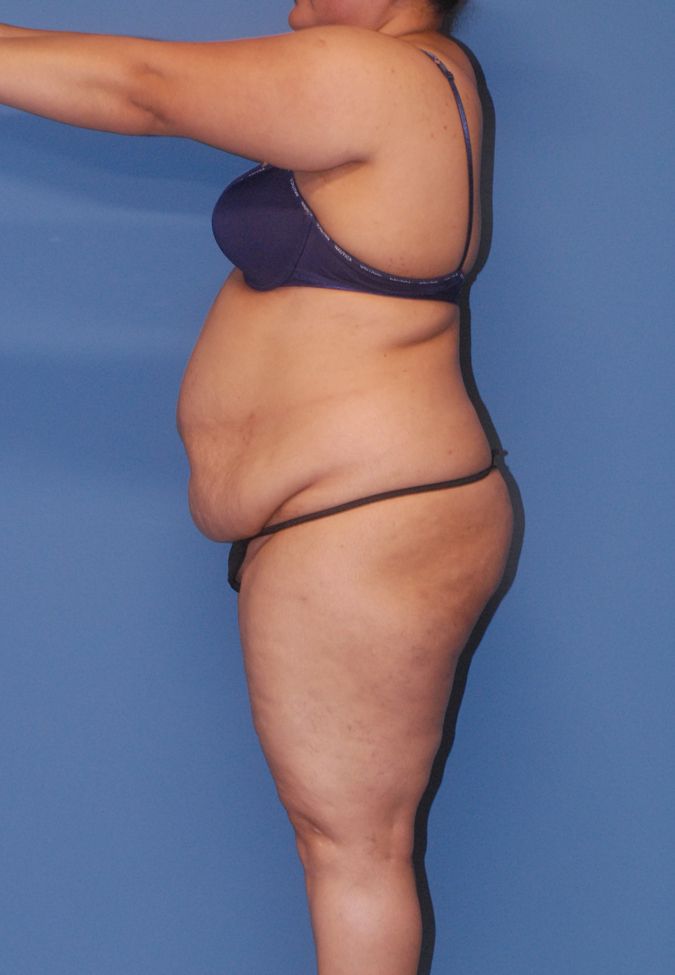 Liposuction Before & After