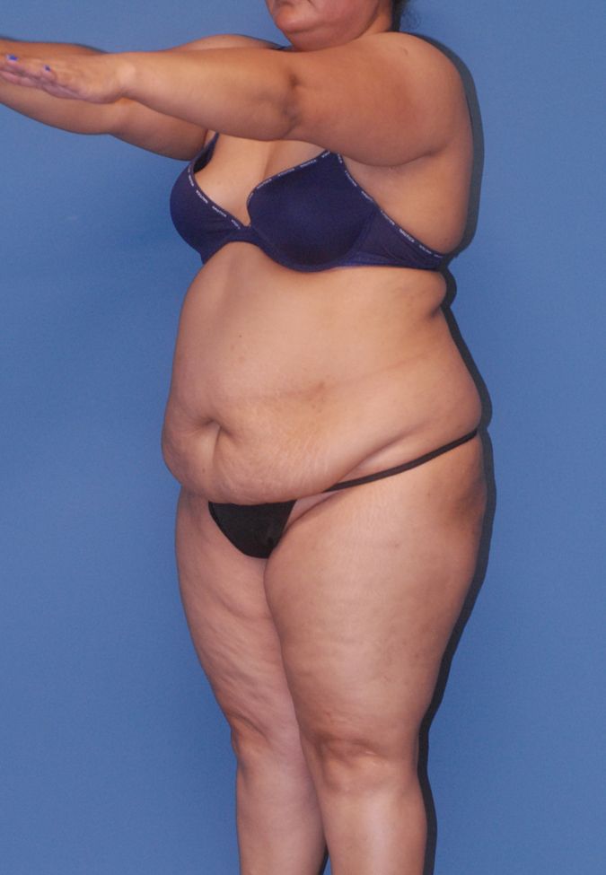 Liposuction Before & After