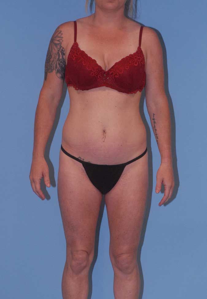 Liposuction Before & After