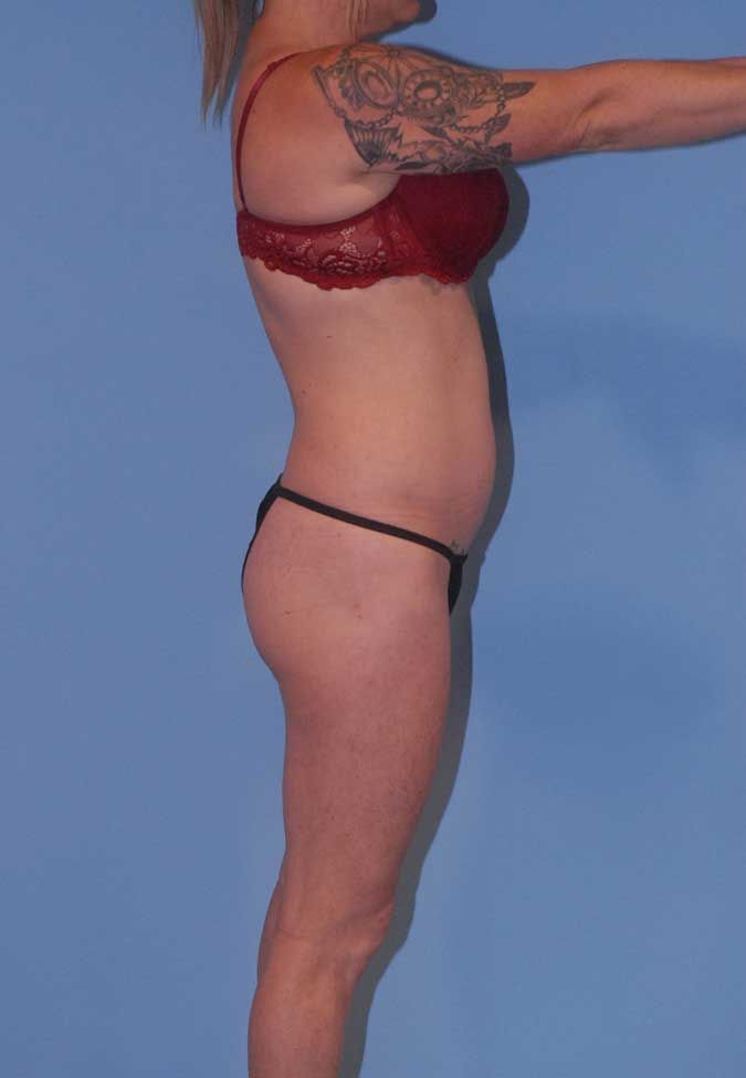 Liposuction Before & After