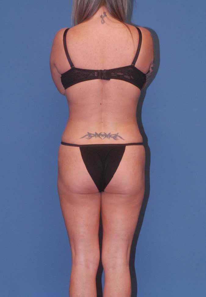 Liposuction Before & After