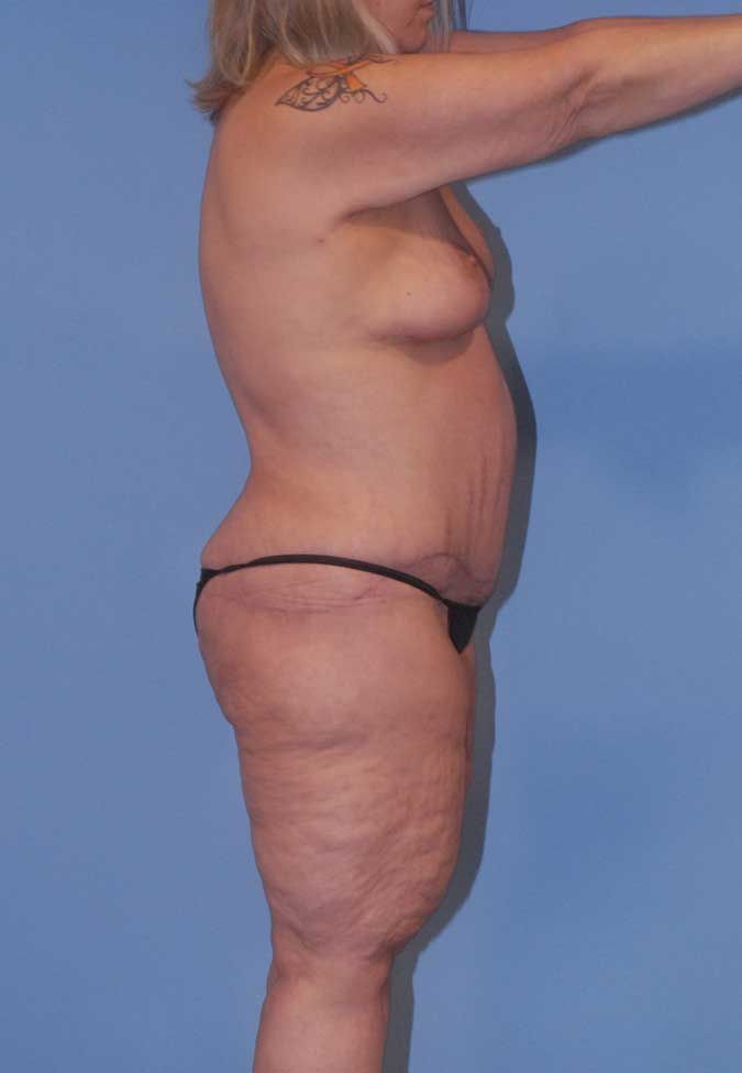 Liposuction Before & After