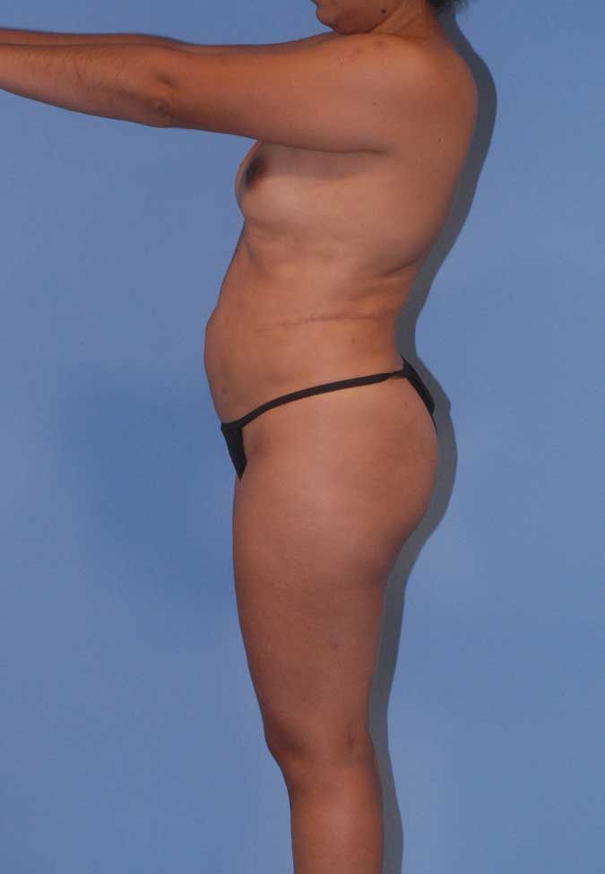 Liposuction Before & After