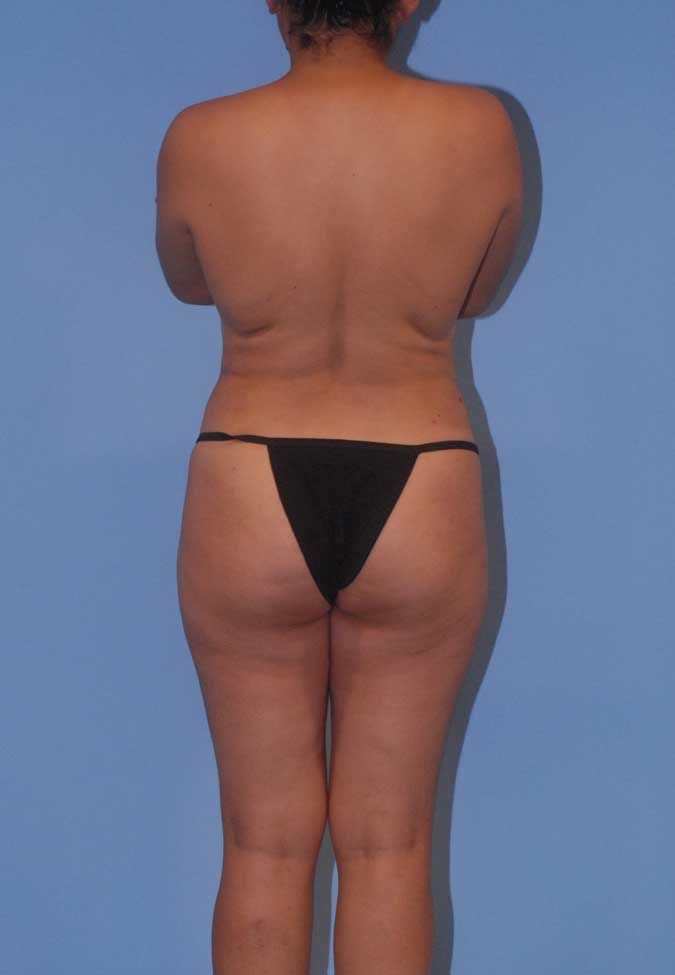 Liposuction Before & After