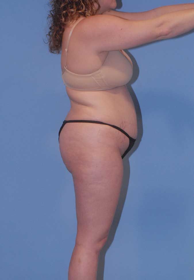 Liposuction Before & After