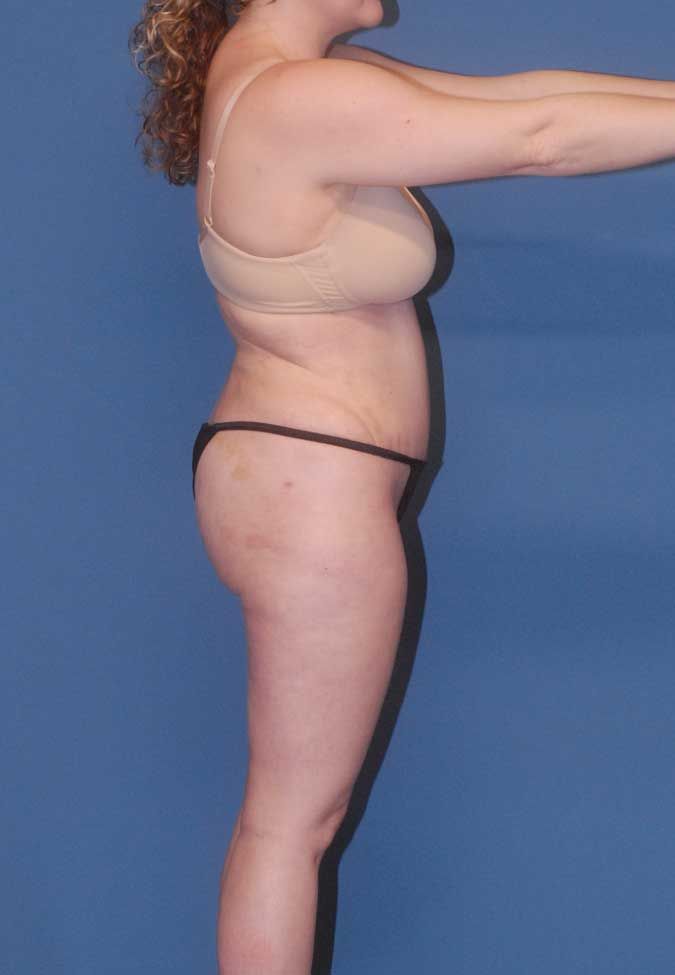 Liposuction Before & After