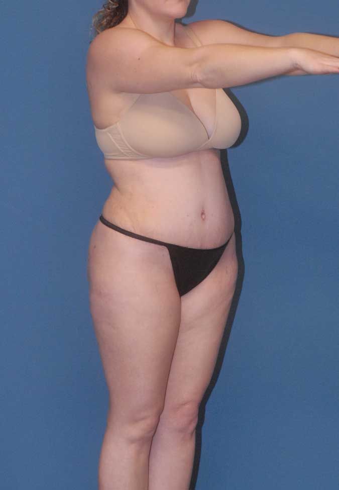 Liposuction Before & After