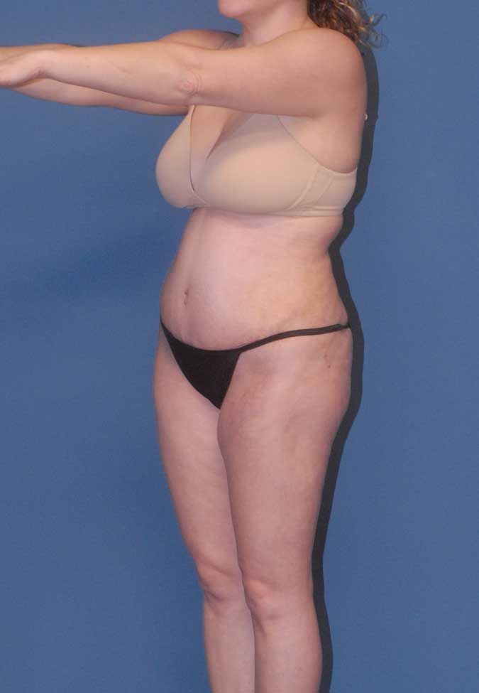 Liposuction Before & After