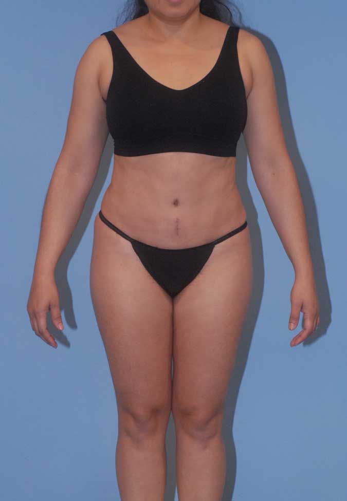 Liposuction Before & After