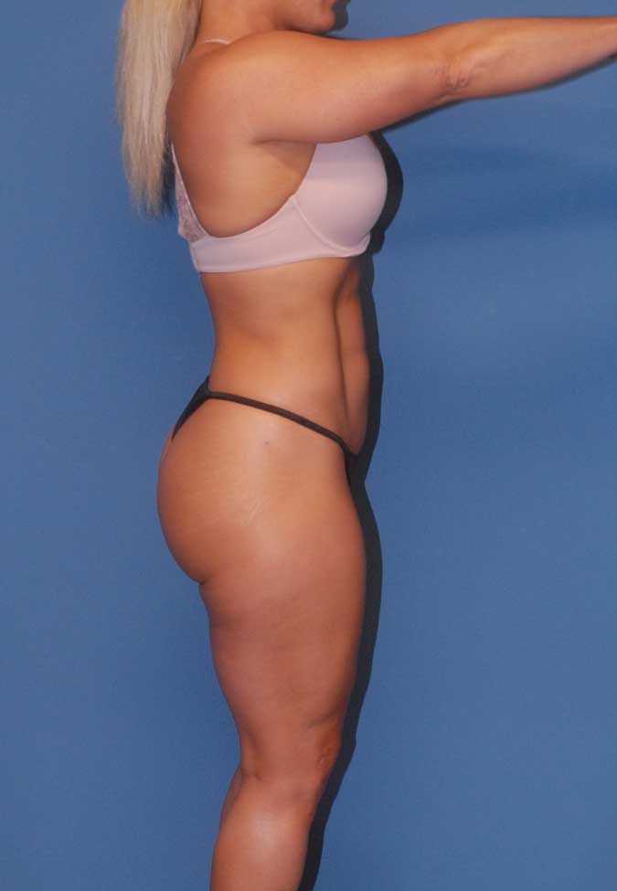 Liposuction Before & After