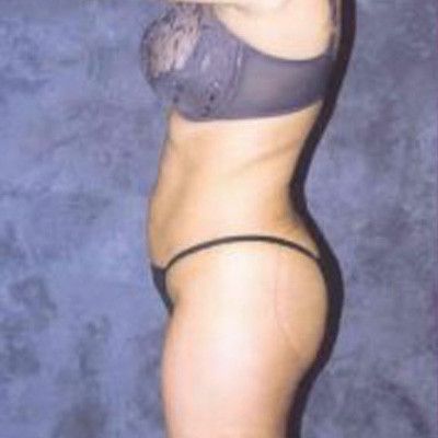 Liposuction Before & After