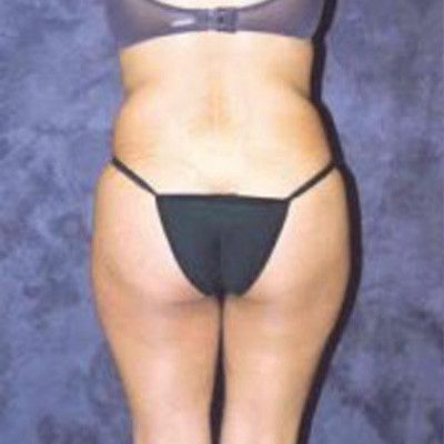 Liposuction Before & After