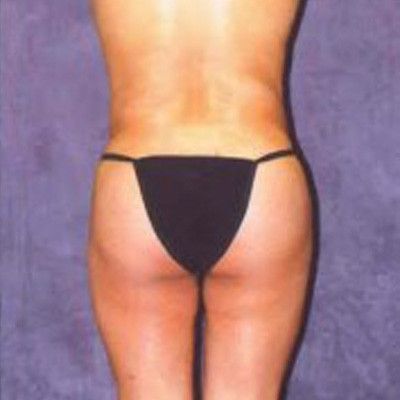 Liposuction Before & After