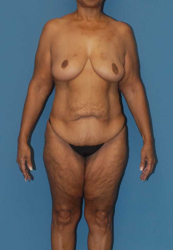 Liposuction Before & After