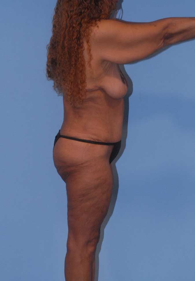 Liposuction Before & After