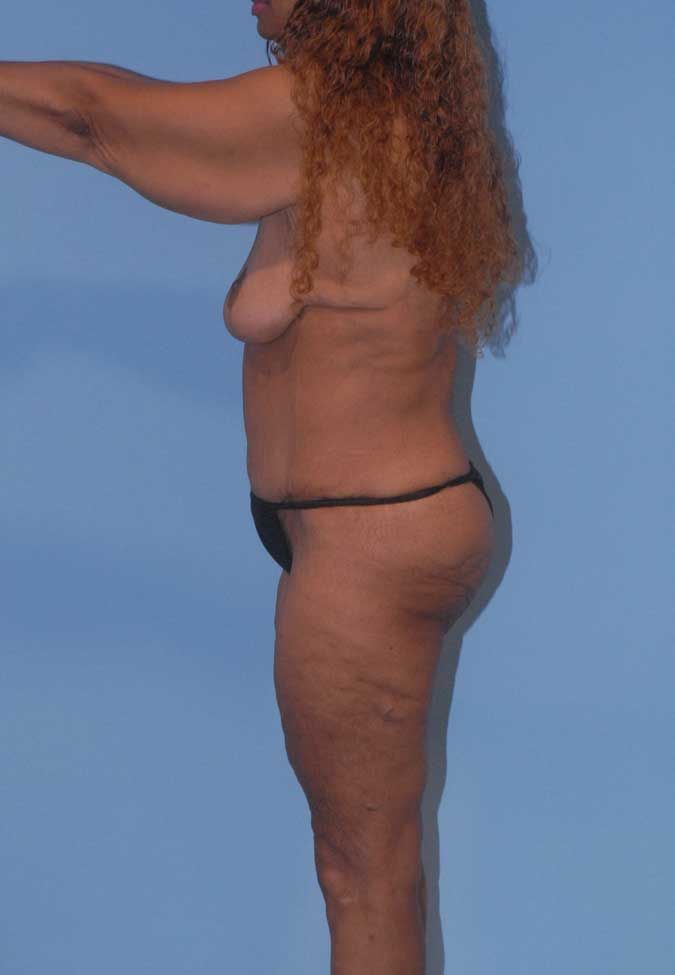 Liposuction Before & After