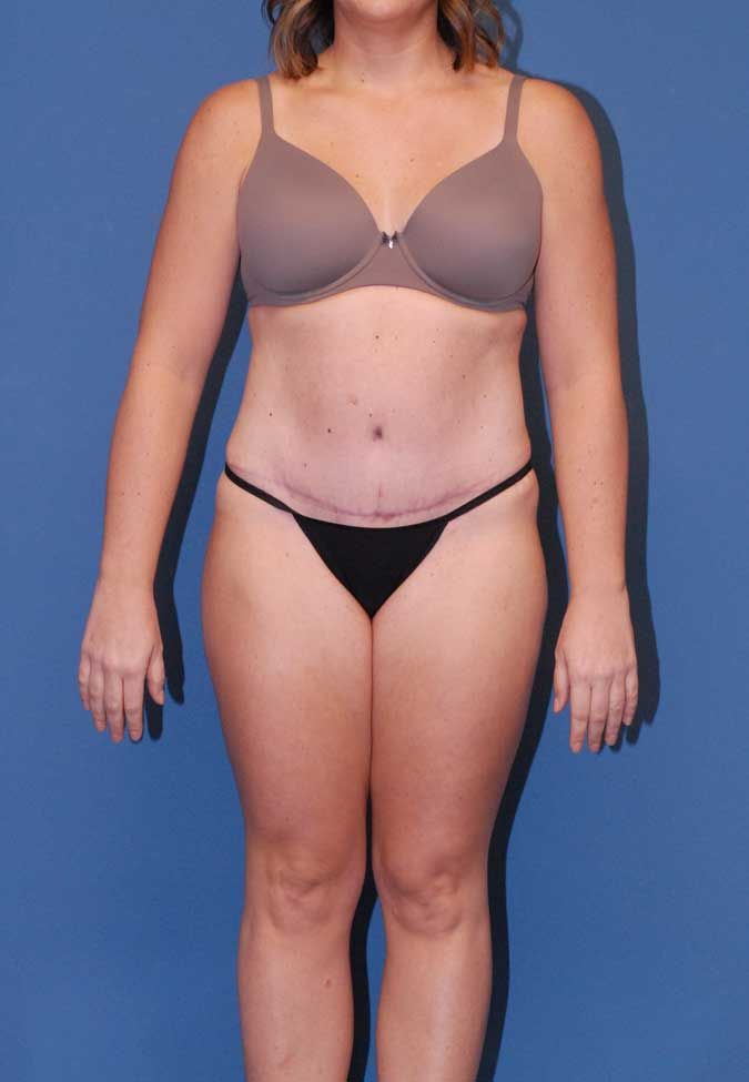 Liposuction Before & After