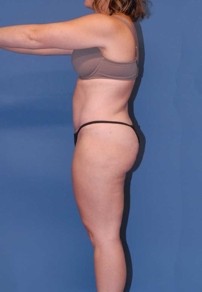 Liposuction Before & After