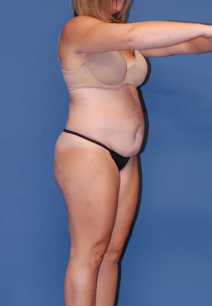 Liposuction Before & After