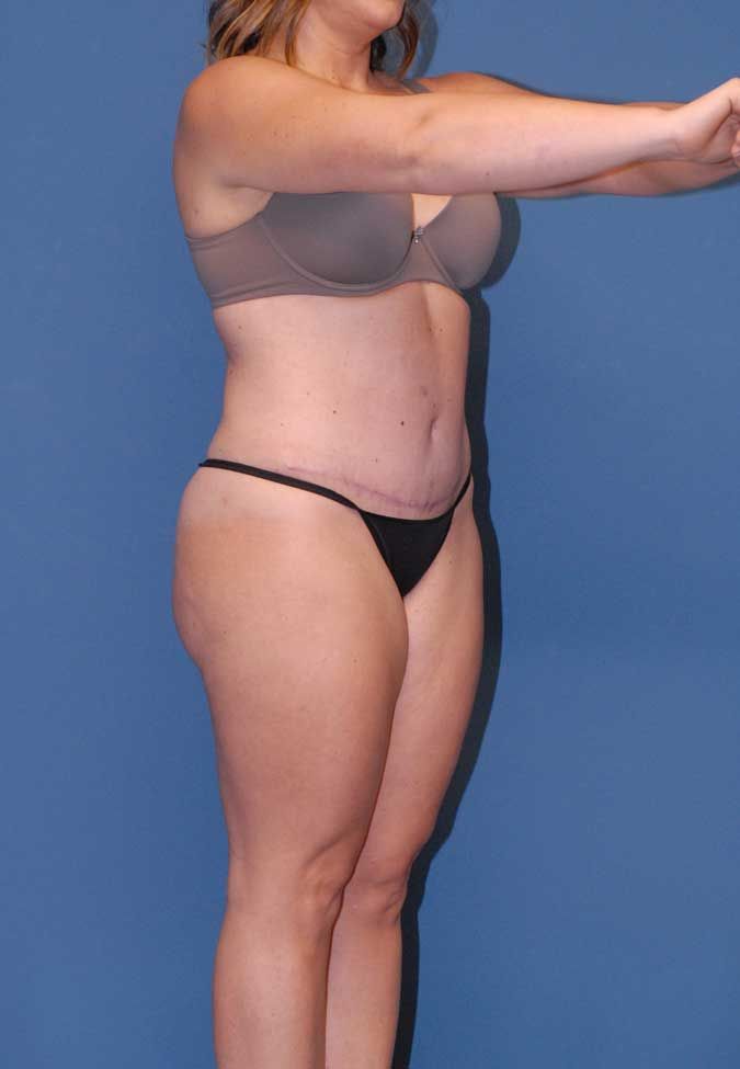 Liposuction Before & After