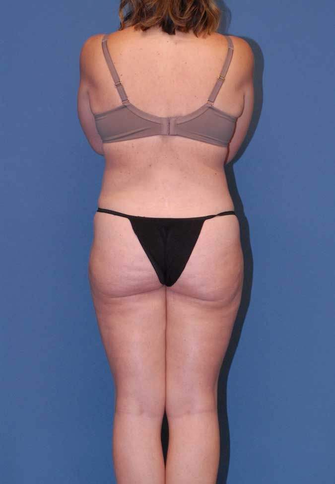 Liposuction Before & After