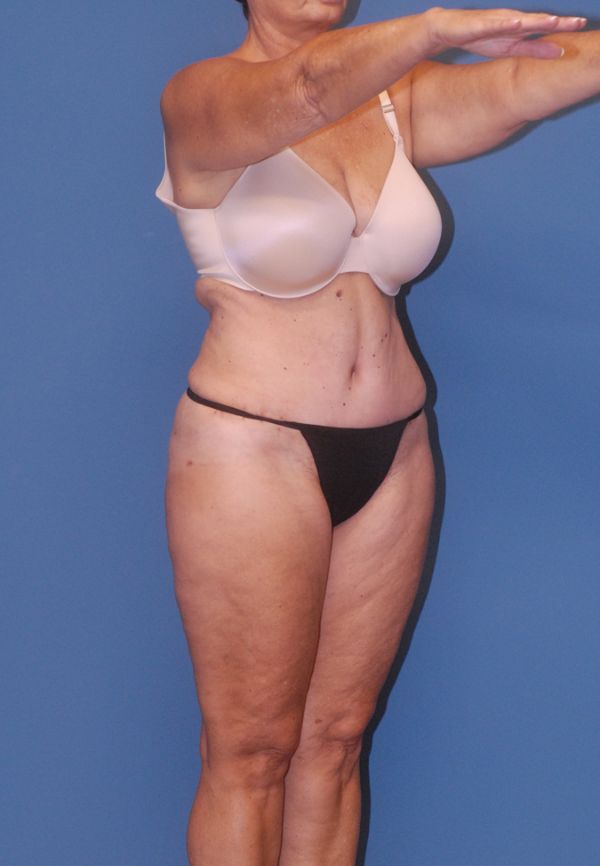 Liposuction Before & After