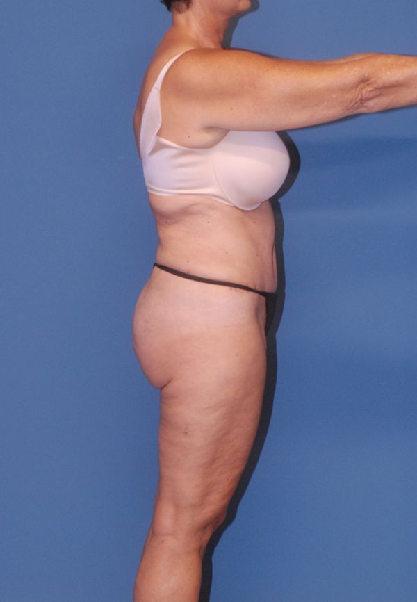 Liposuction Before & After