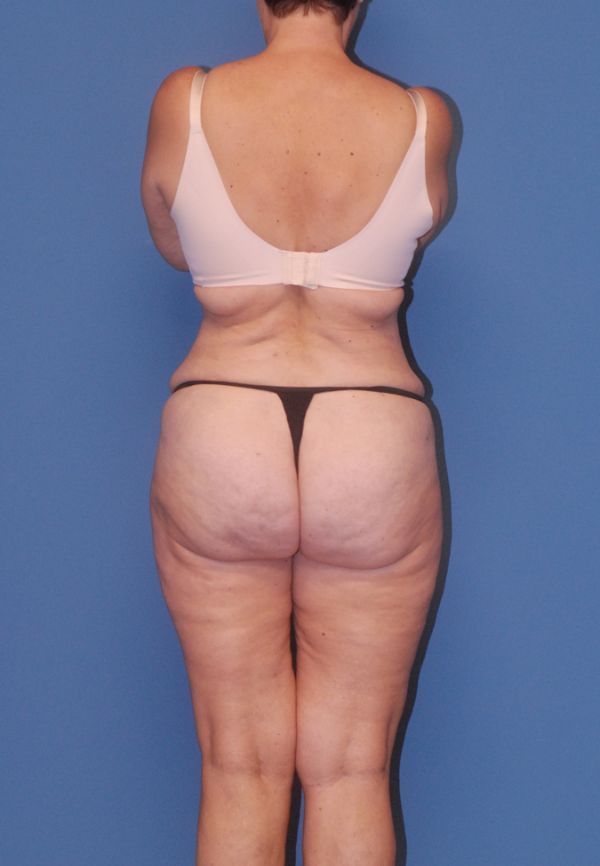 Liposuction Before & After