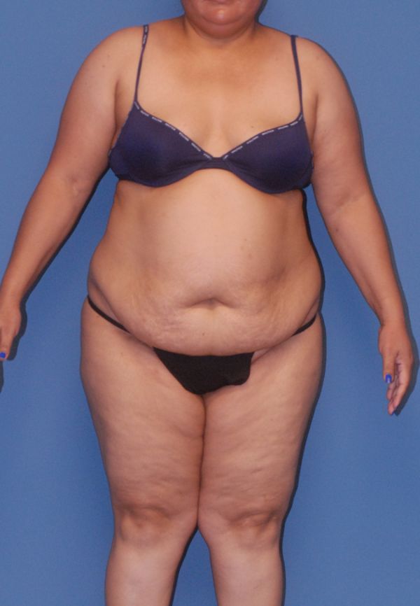 Liposuction Before & After