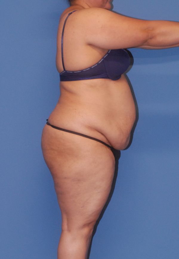 Liposuction Before & After