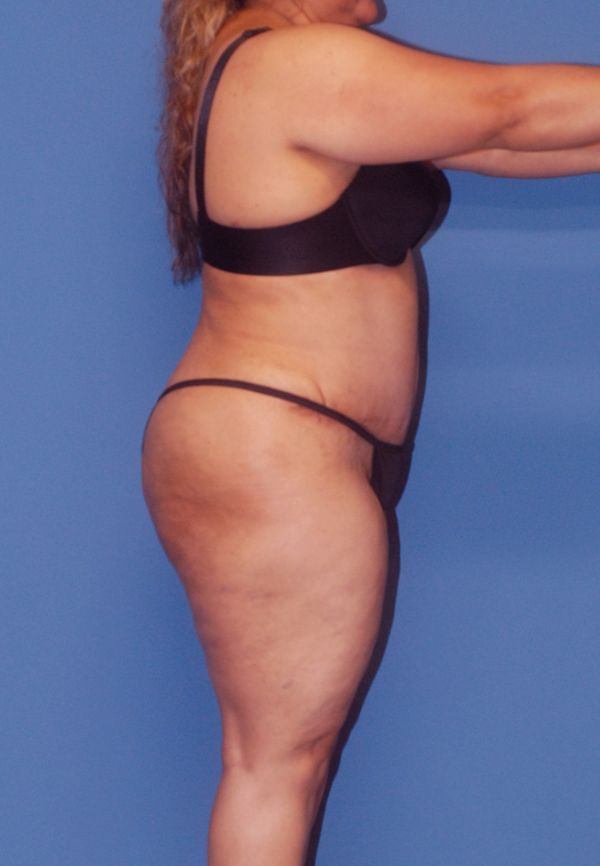 Liposuction Before & After