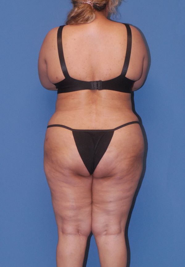 Liposuction Before & After