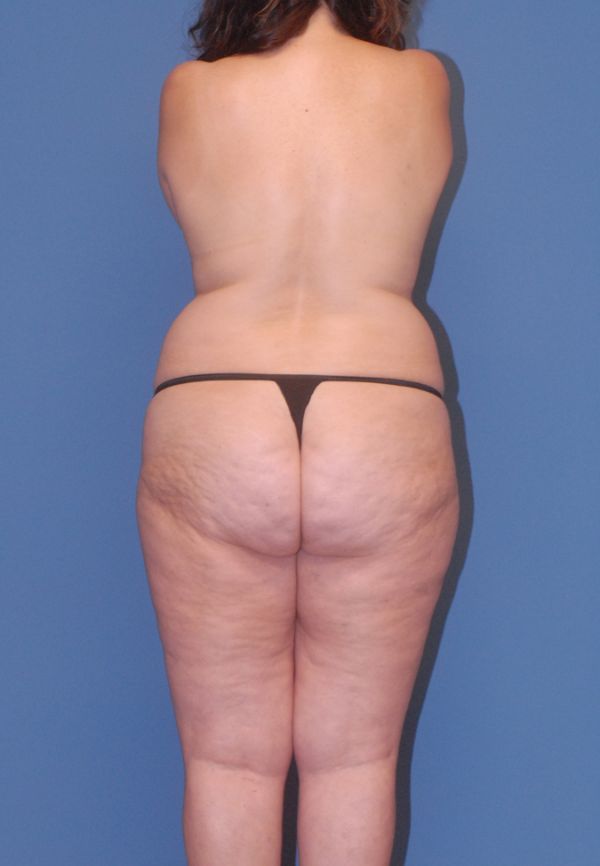 Liposuction Before & After
