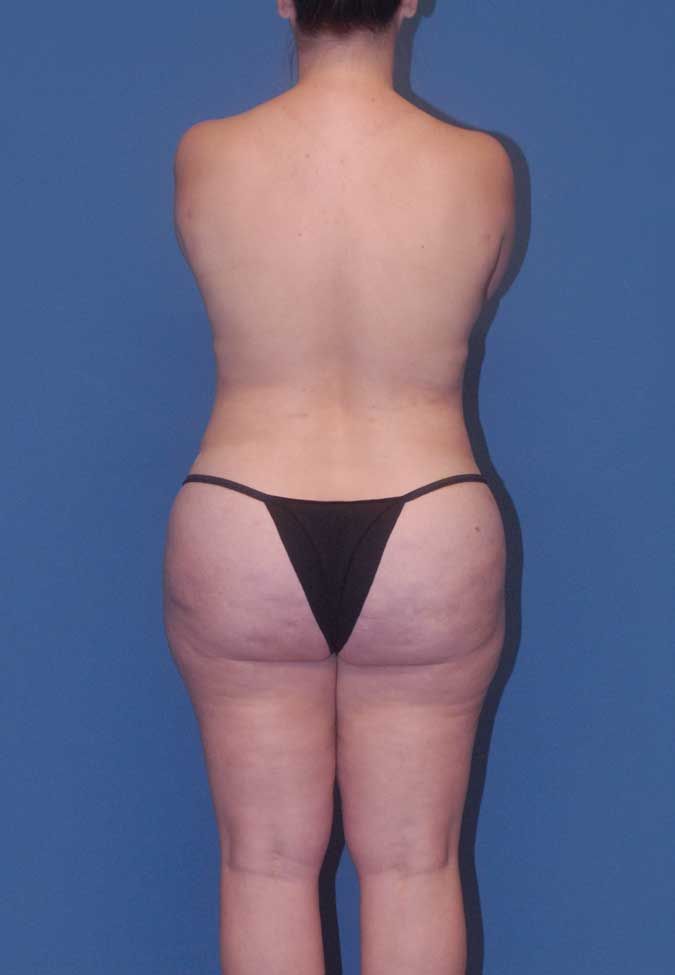 Liposuction Before & After