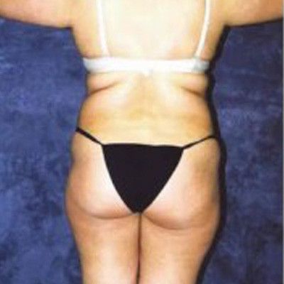 Liposuction Before & After