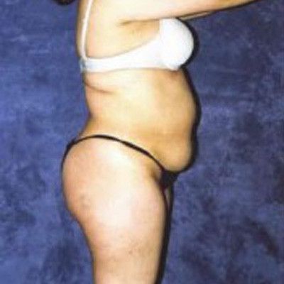 Liposuction Before & After