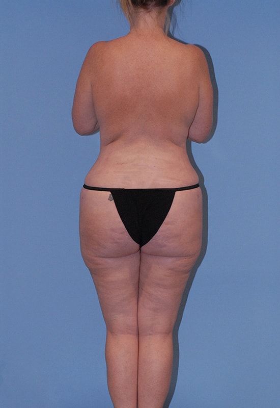 Liposuction Before & After
